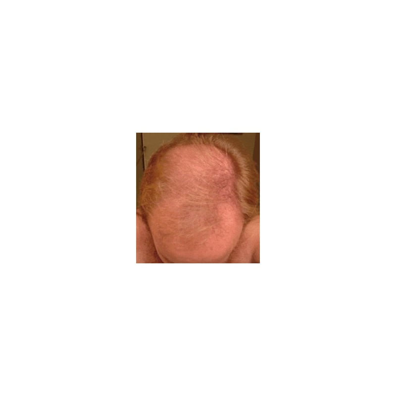 Foligain Minoxidil 5% - Regenerarea parului pentru barbati, 3 luni - 2 | YEO