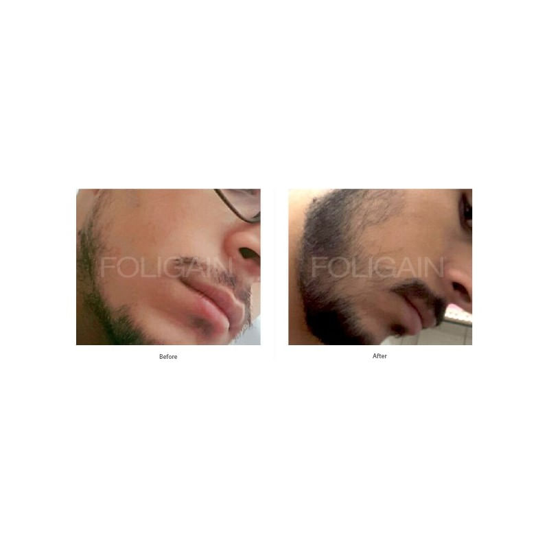 Foligain Minoxidil 5% Solutie cresterea parului barbati (Alcool scazut) 3 luni - 1 | YEO