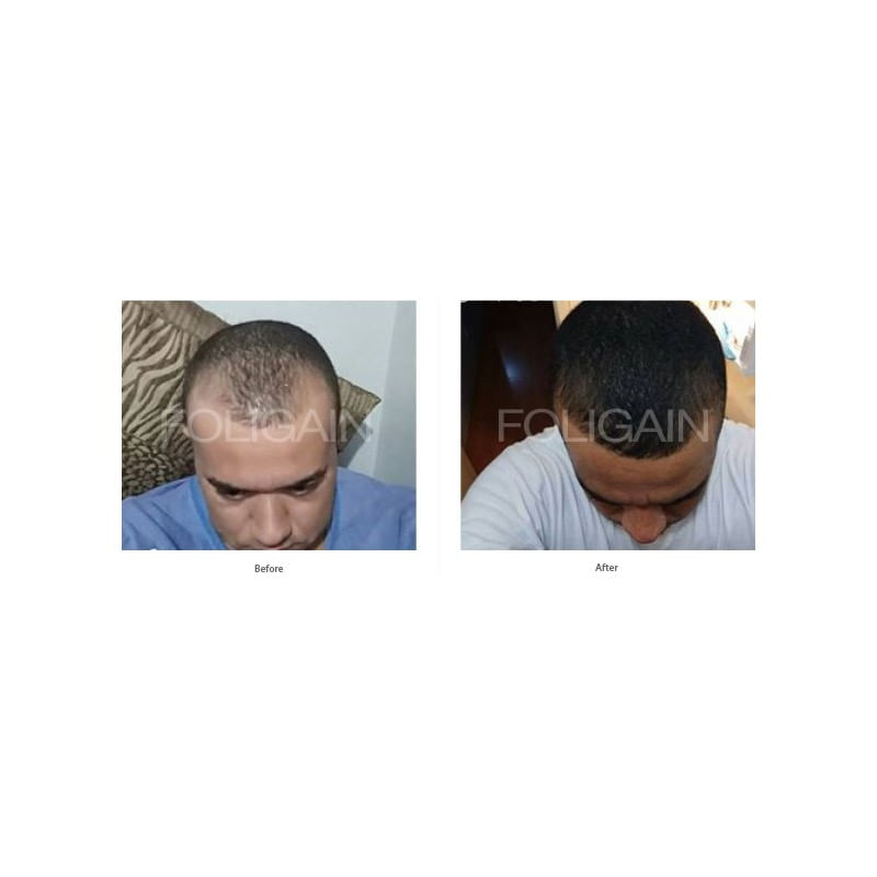 Foligain Minoxidil 5% Solutie cresterea parului barbati (Alcool scazut) 3 luni - 3 | YEO